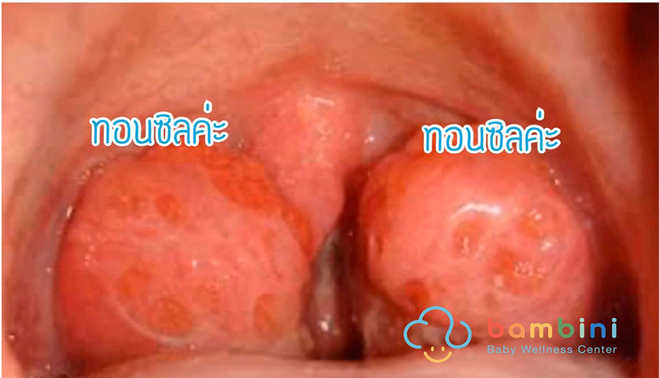 การนอนกรนในเด็ก ไม่ใช่เรื่องเล็กอีกต่อไป